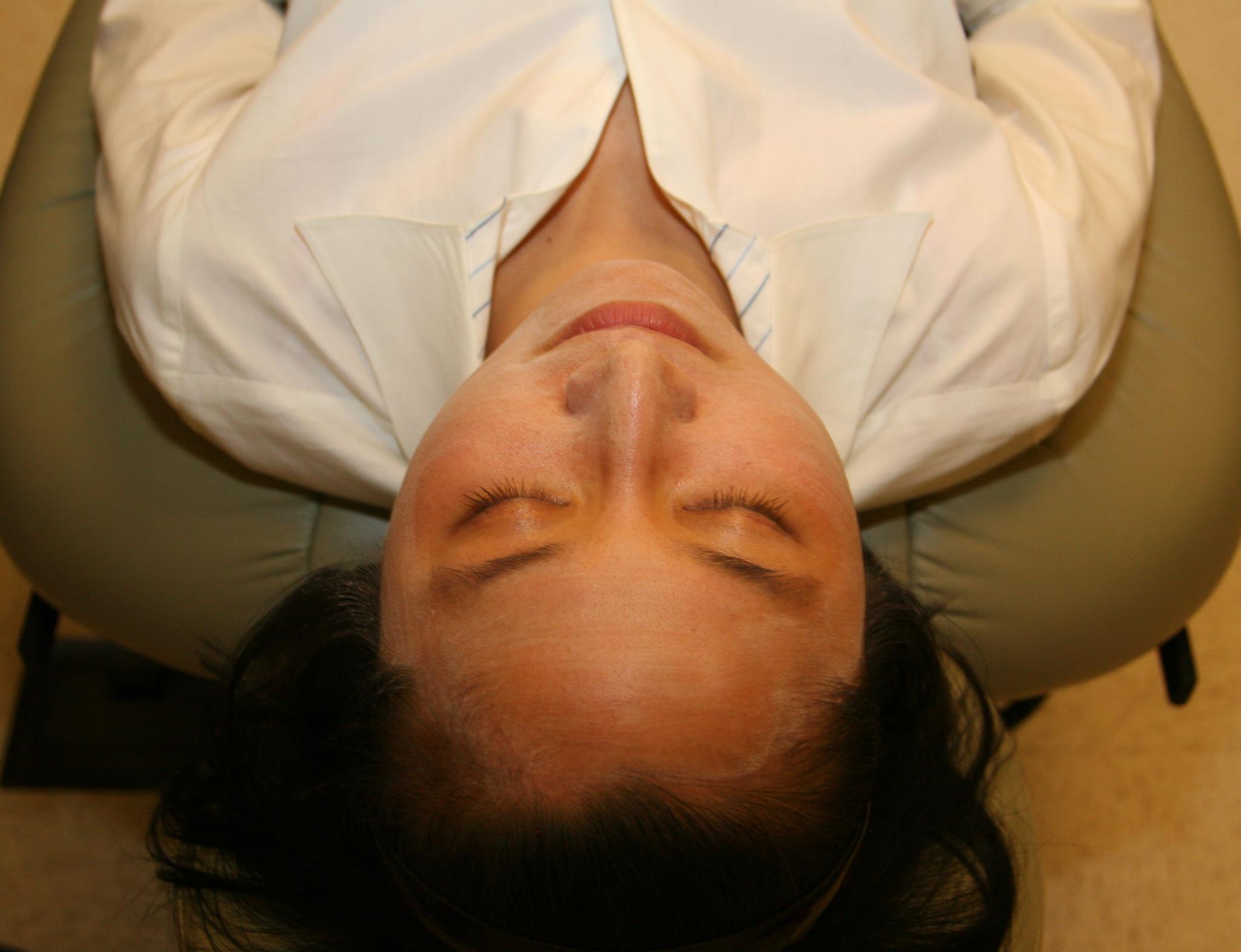 frosting can be seen on the face from the chemical peel which is an acid